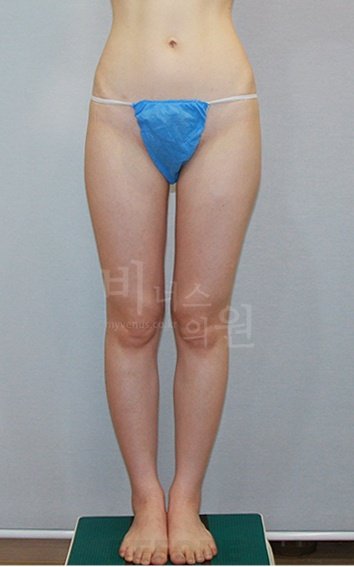 허벅지 맥시머C 지방흡입 수술 전 후면