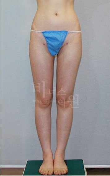 허벅지 맥시머C 지방흡입 수술 후 후면