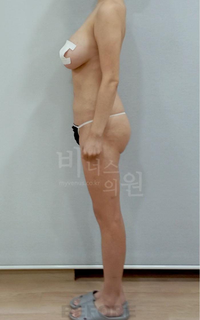 엉덩이 지방흡입 수술 전 우측면 — 부천 비너스의원