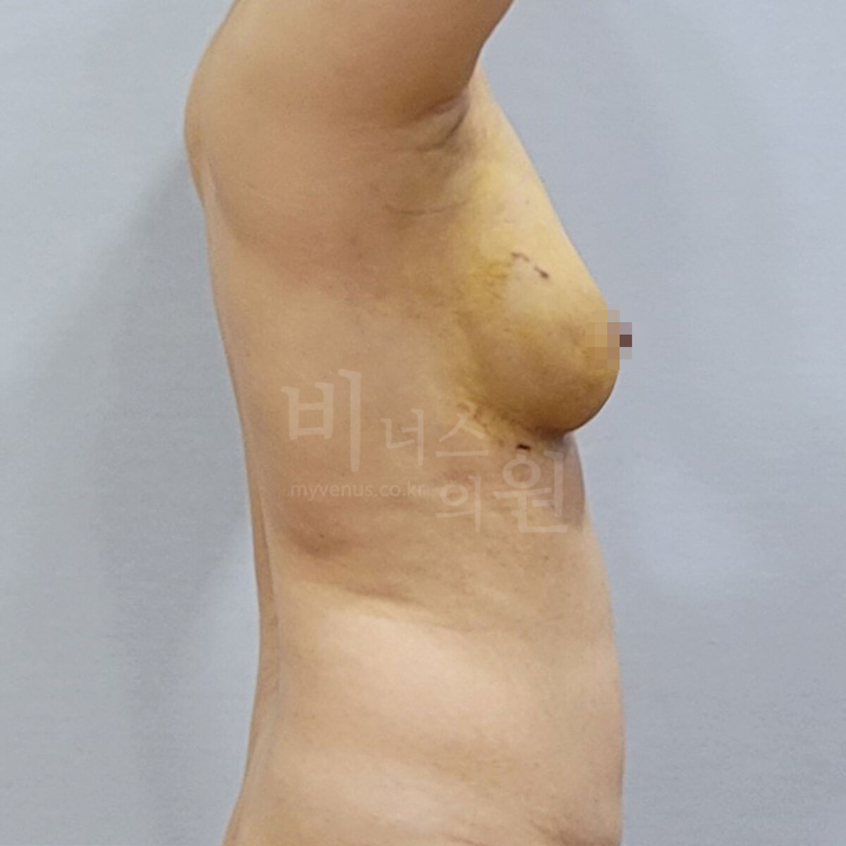 유방하수 표층 지방흡입 수술 후 측면 비너스의원