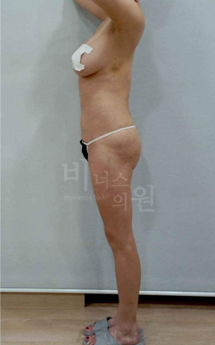 엉덩이 지방흡입 수술 후 우측면 팔 올림 자세 — 힙업 힙라인