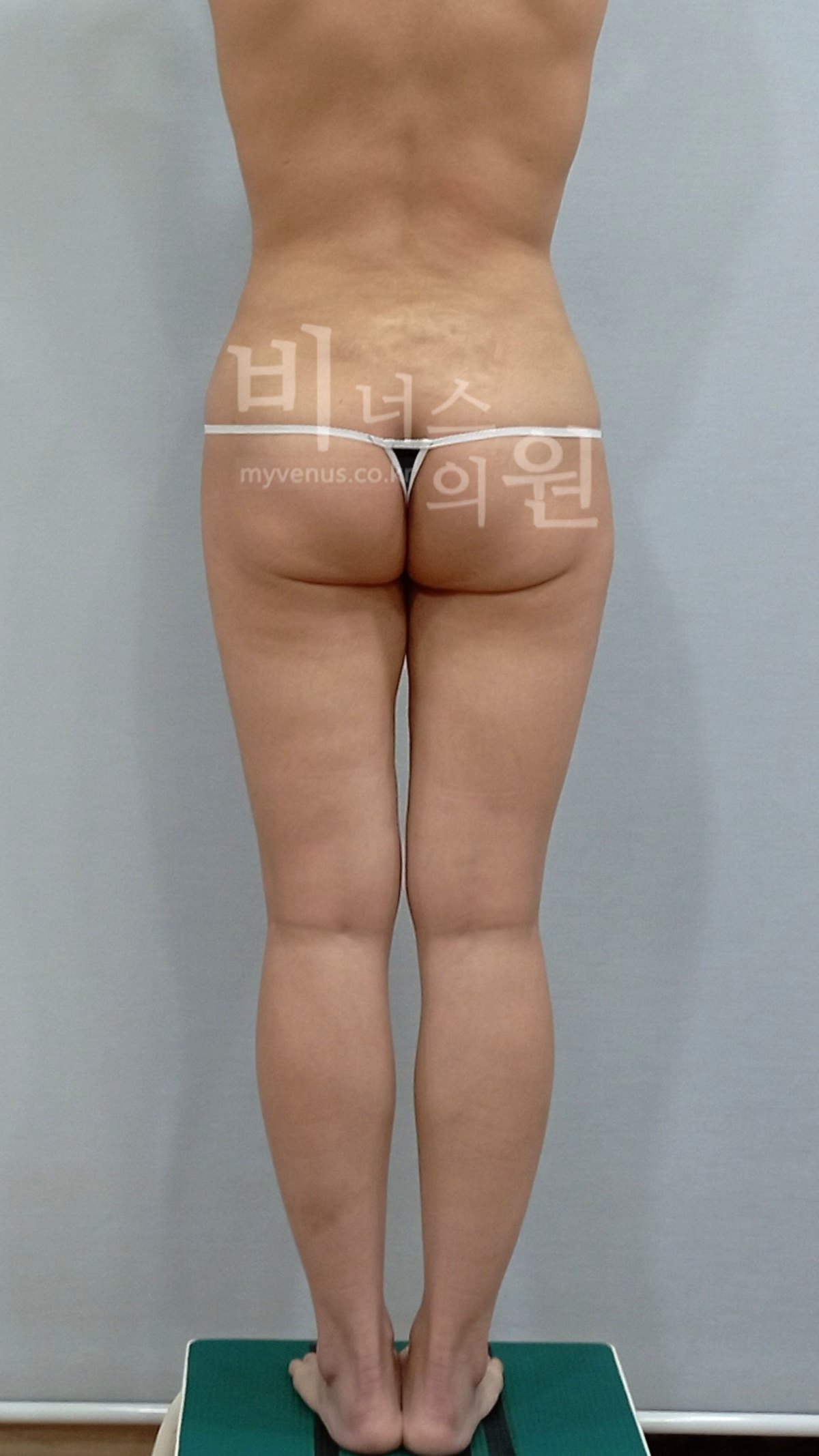 엉덩이축소 지방흡입 수술 전 후면 비너스의원