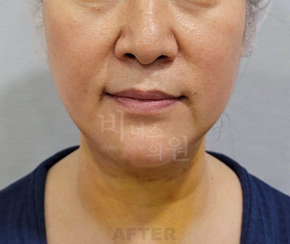 이중턱·목 지방흡입 수술 후 정면 비너스의원