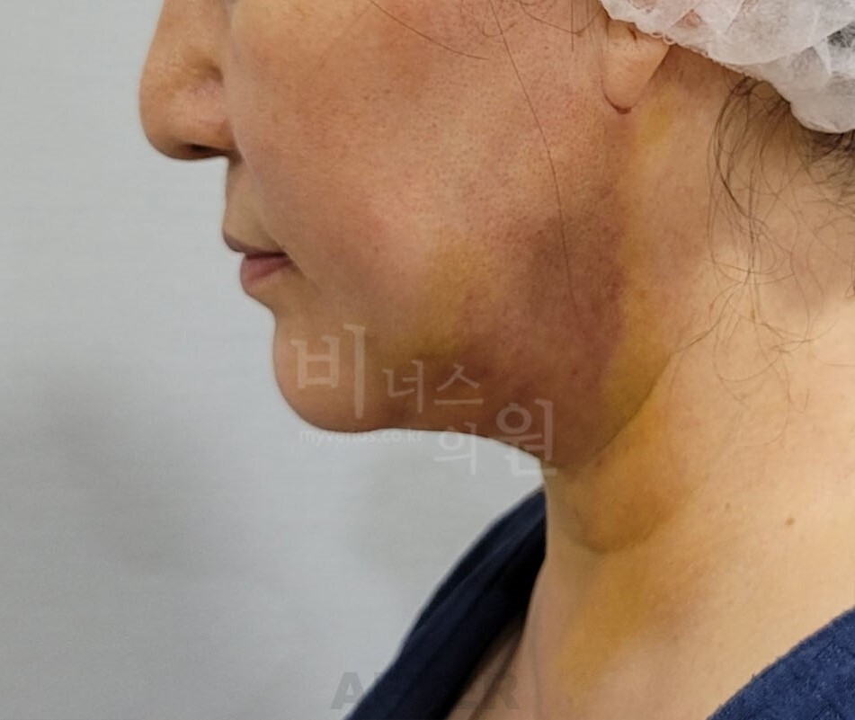 얼굴 지방흡입 수술 후 우측면 턱과 목 라인 비너스의원