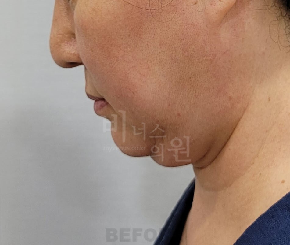 얼굴 지방흡입 수술 전 우측면 턱과 목 라인 비너스의원