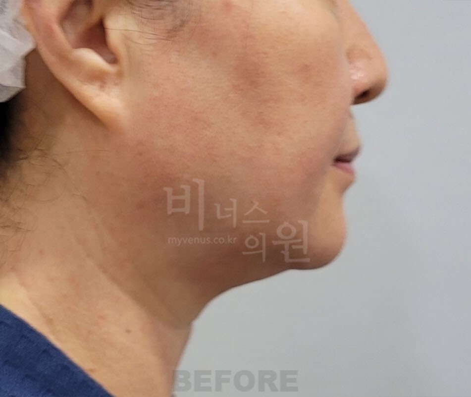 얼굴 지방흡입 수술 전 좌측면 턱과 목 라인 비너스의원