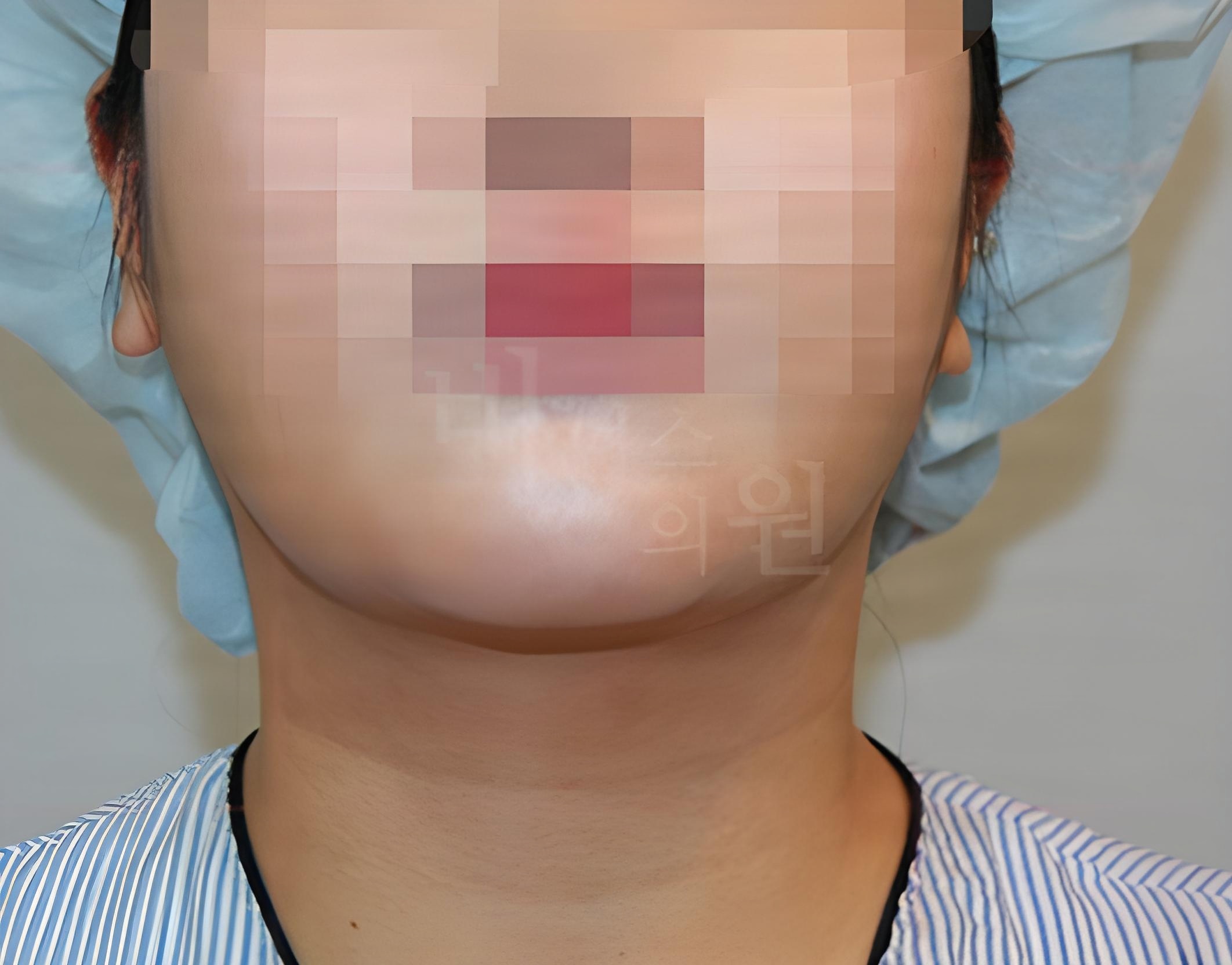 턱 지방흡입 수술 후 정면 사례 2 비너스의원