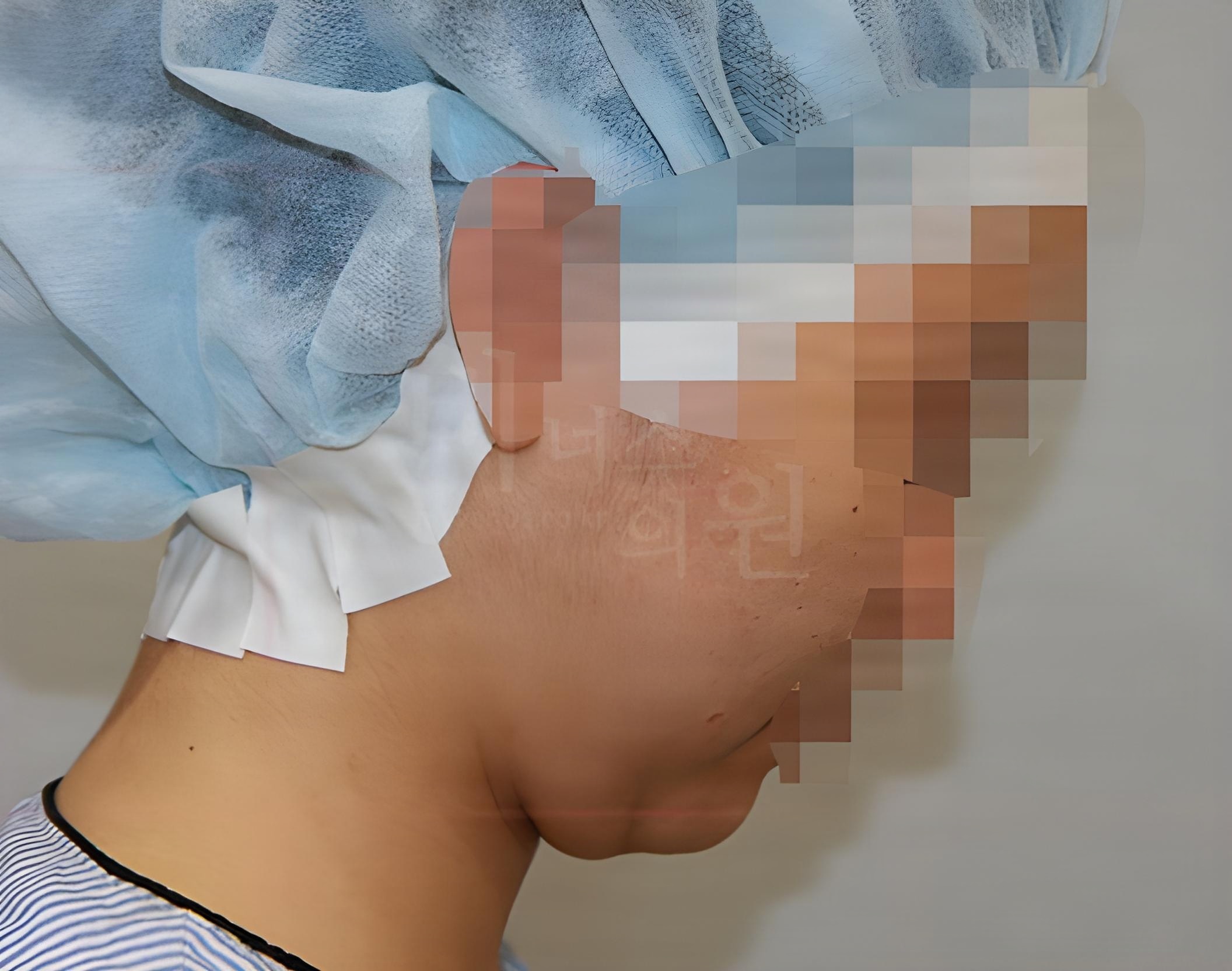 턱 지방흡입 수술 전 측면 사례 1 비너스의원