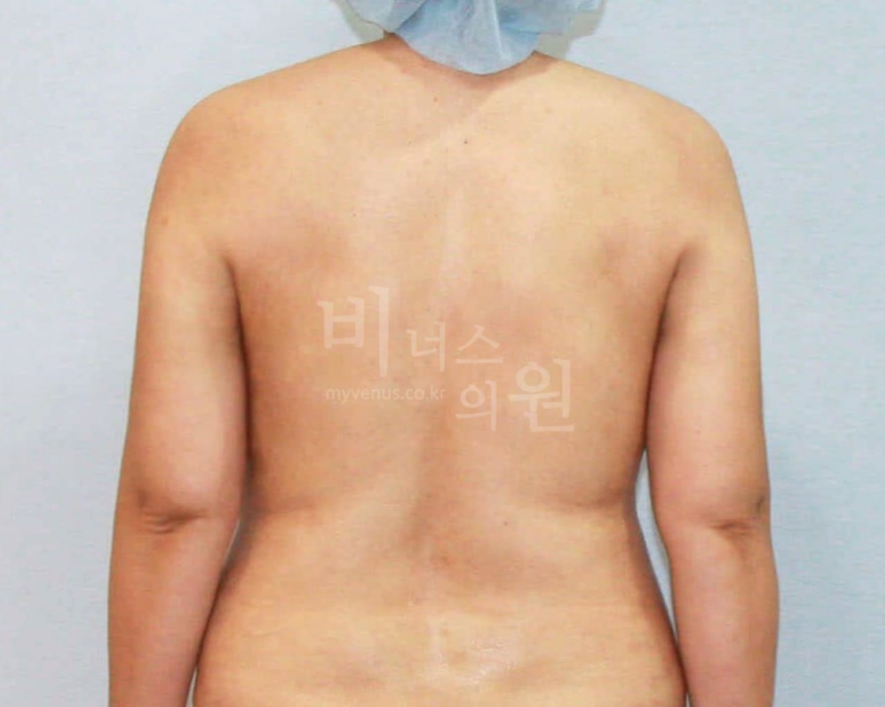 팔뚝 지방흡입 전후 — 등·후면(팔 내린) 수술 후 — 비너스의원