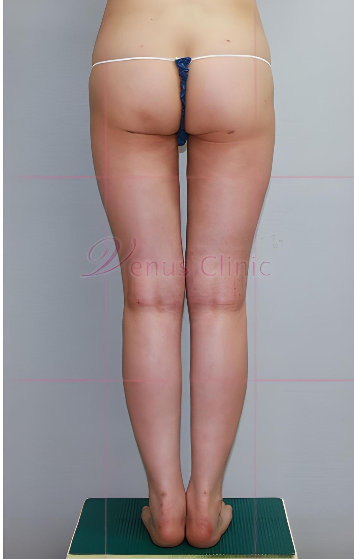 엉덩이 볼륨업 지방흡입 수술 후 후면