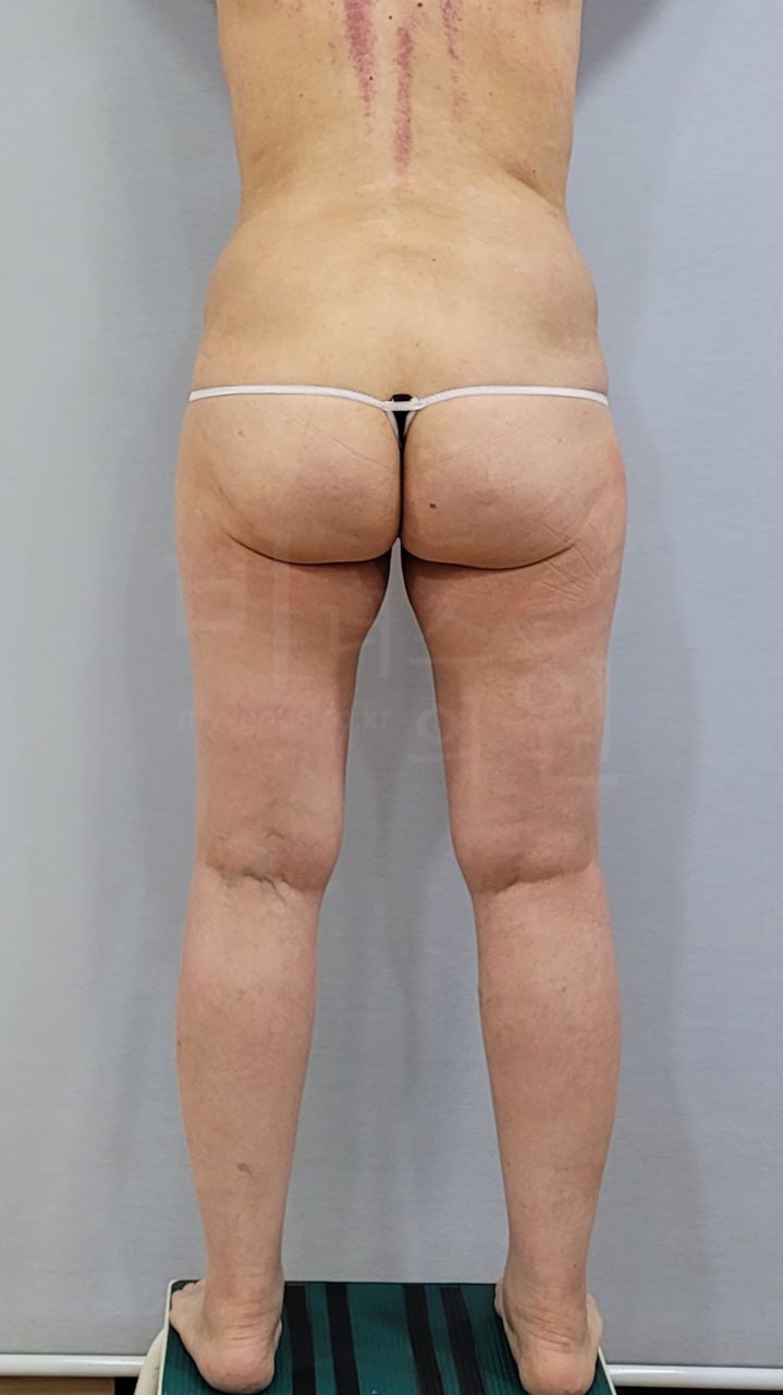 엉덩이 볼륨업 지방흡입 후 후면 클로즈업