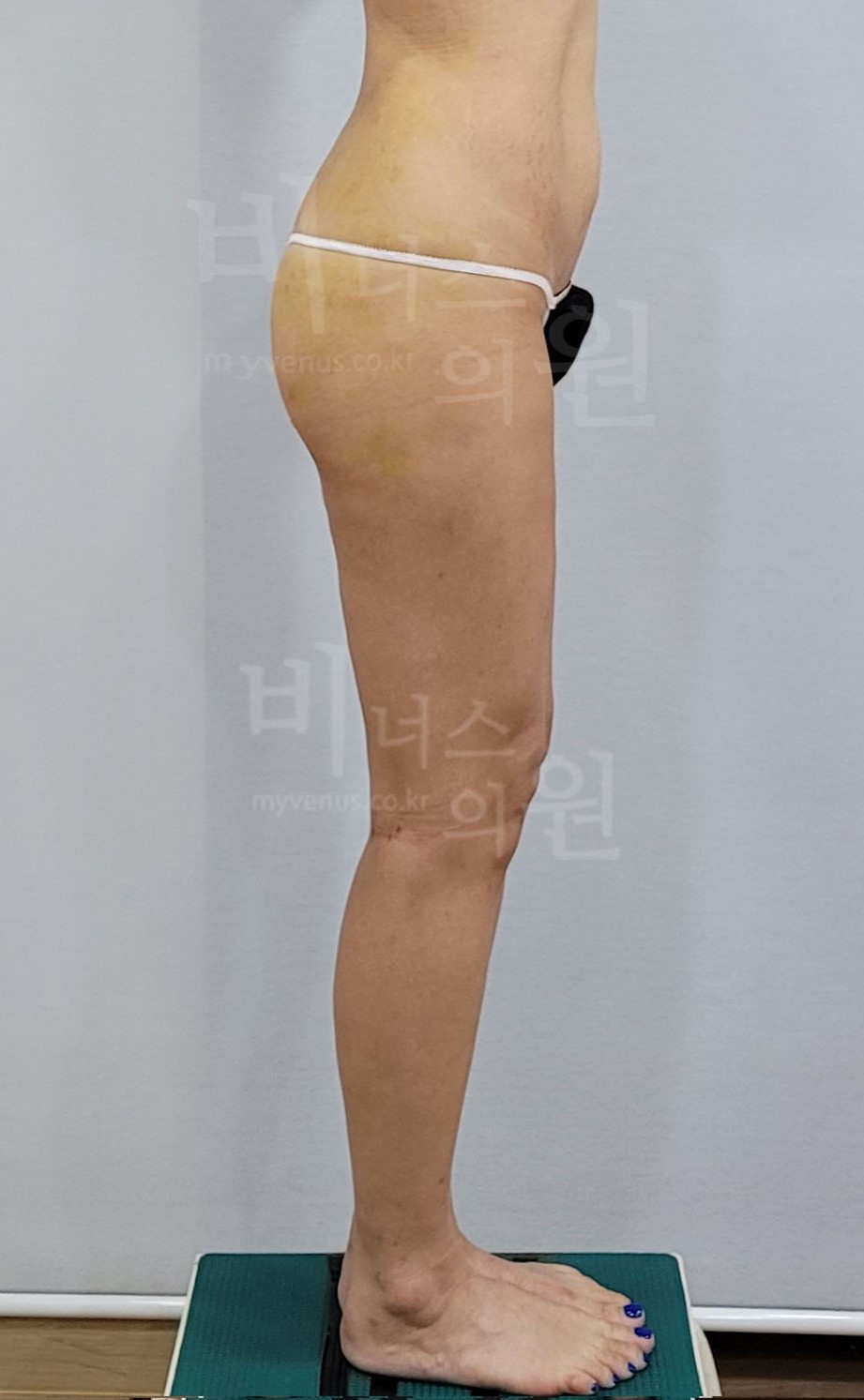 엉덩이축소 지방흡입 수술 후 측면 비너스의원
