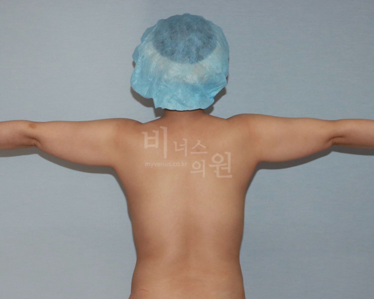 팔뚝 지방흡입 수술 전 후면 팔 T자 벌림 비너스의원