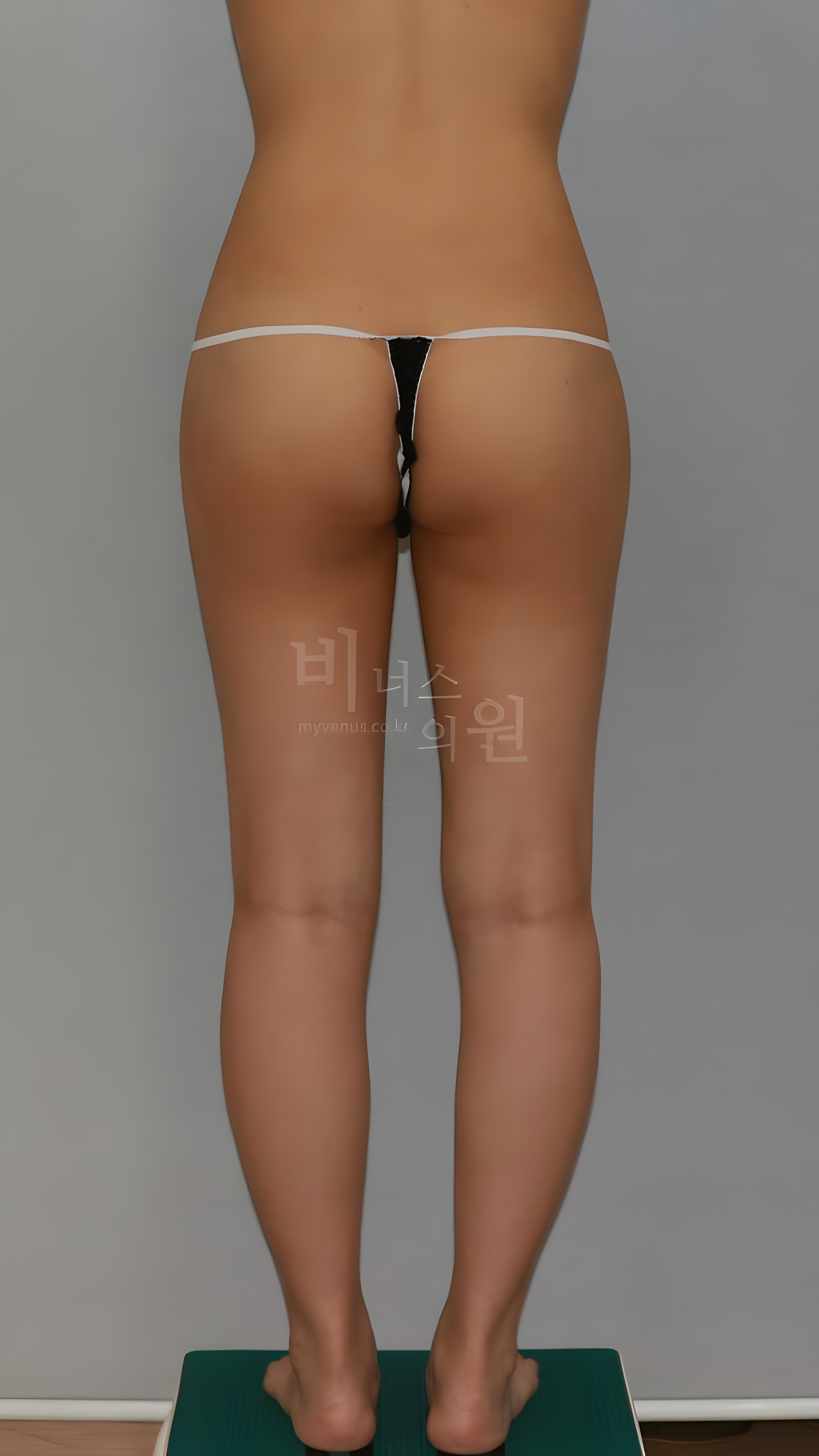 엉덩이 볼륨업 지방흡입 수술 후 후면 비너스의원