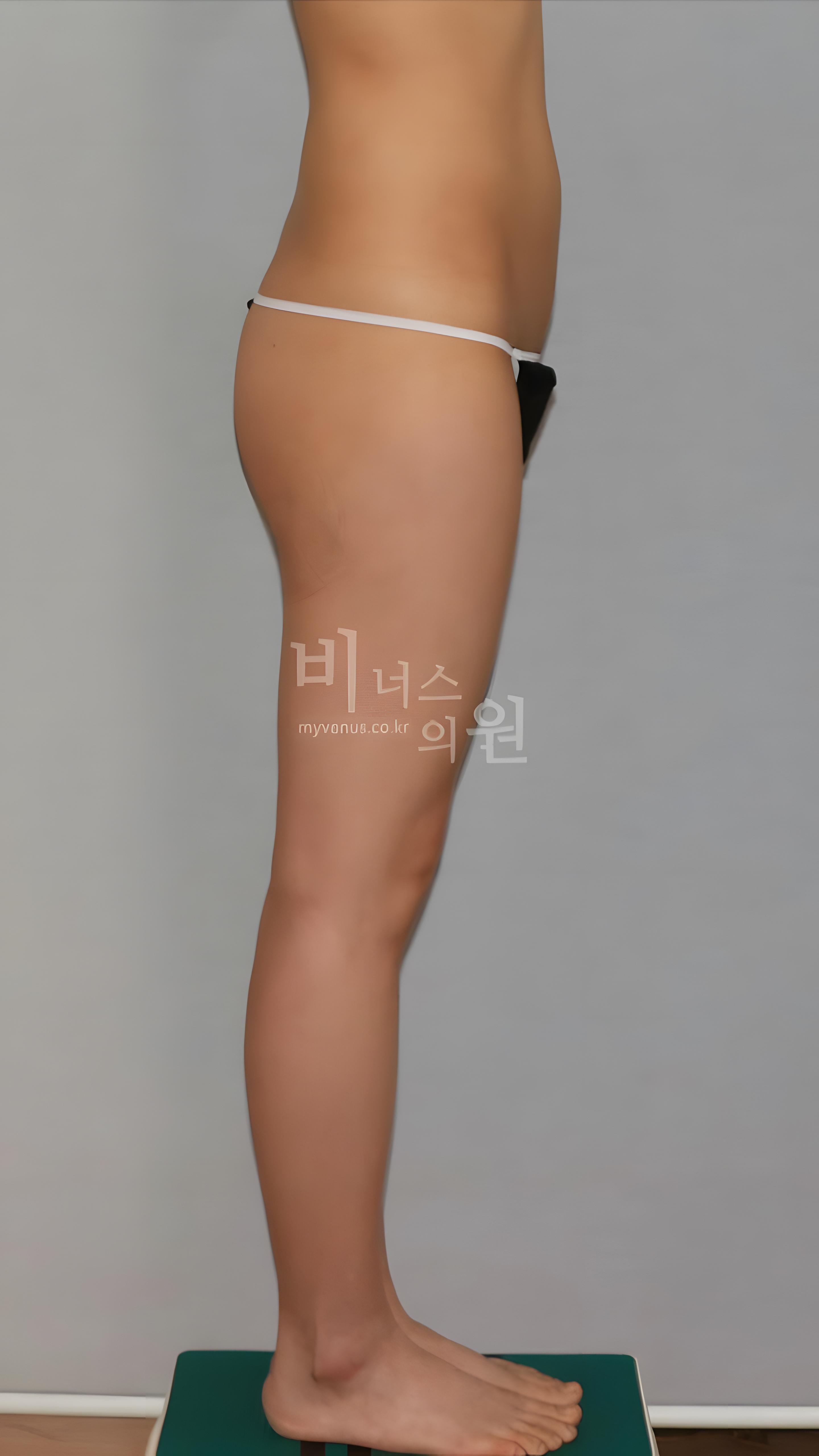 엉덩이 볼륨업 지방흡입 수술 후 측면 비너스의원