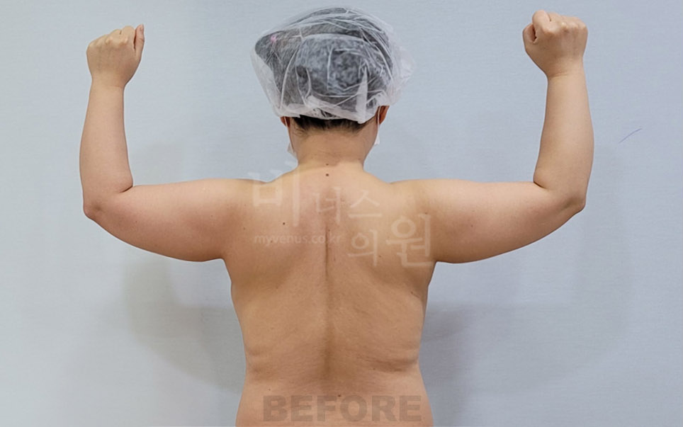 팔 지방흡입 수술 전 후면 팔 올림 자세 비너스의원