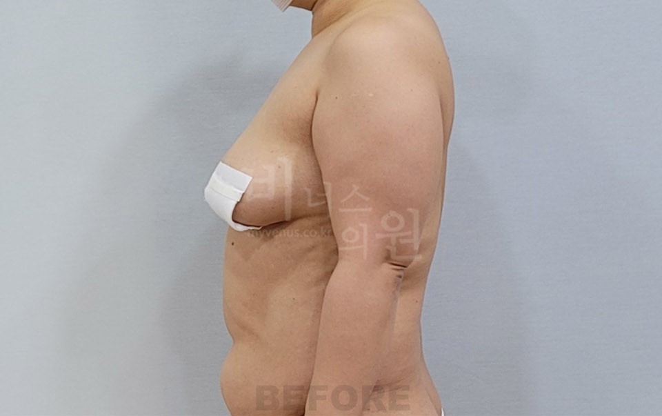 팔 지방흡입 수술 전 측면 자세 비너스의원