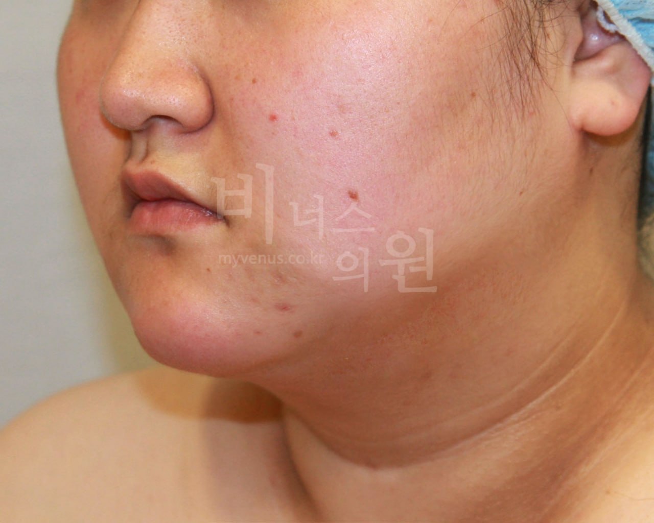 턱지방흡입 전후 사례2 수술 후 비너스의원