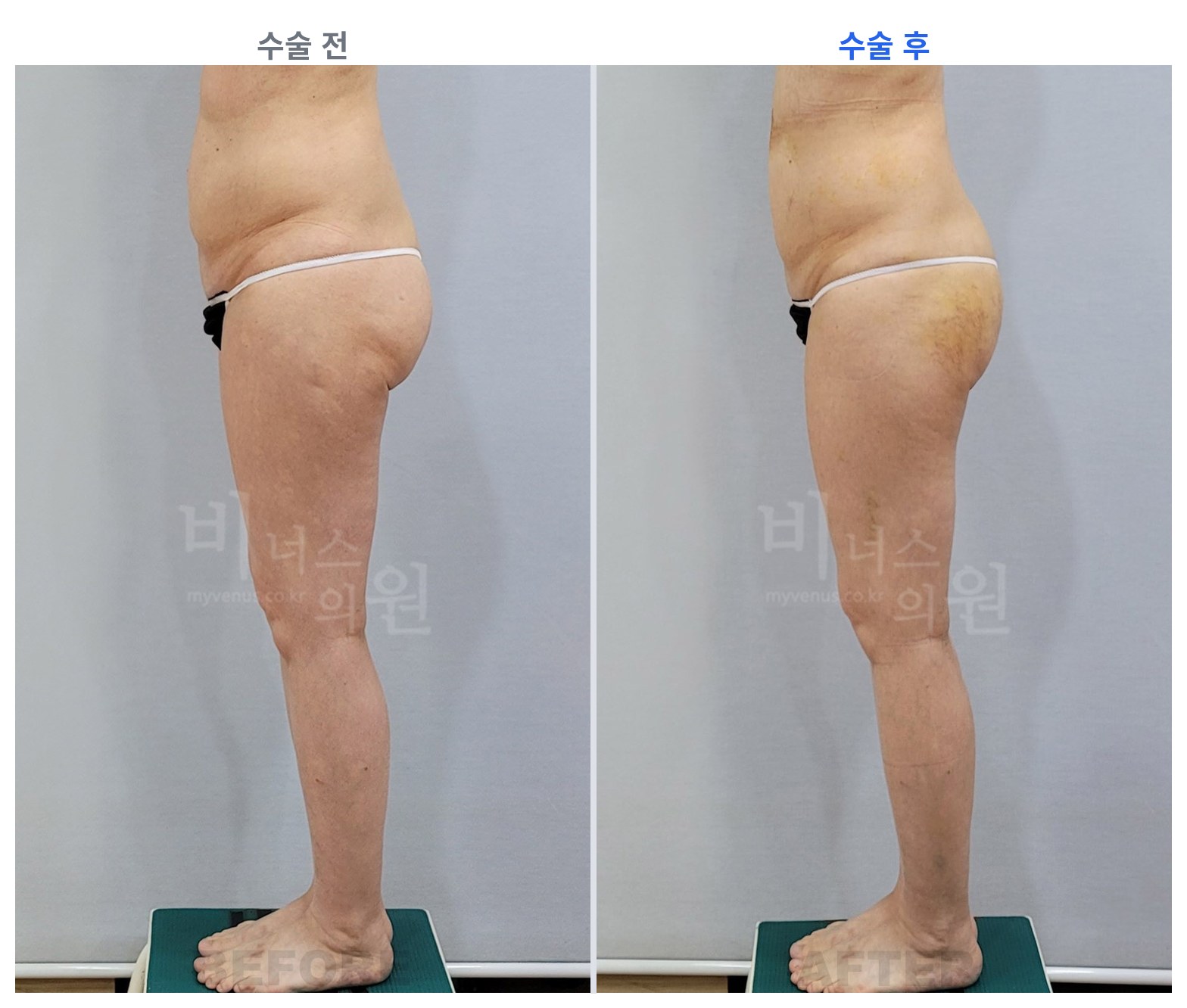 엉덩이축소 지방흡입 수술 전후 측면 비교 애플힙 볼륨 비너스의원
