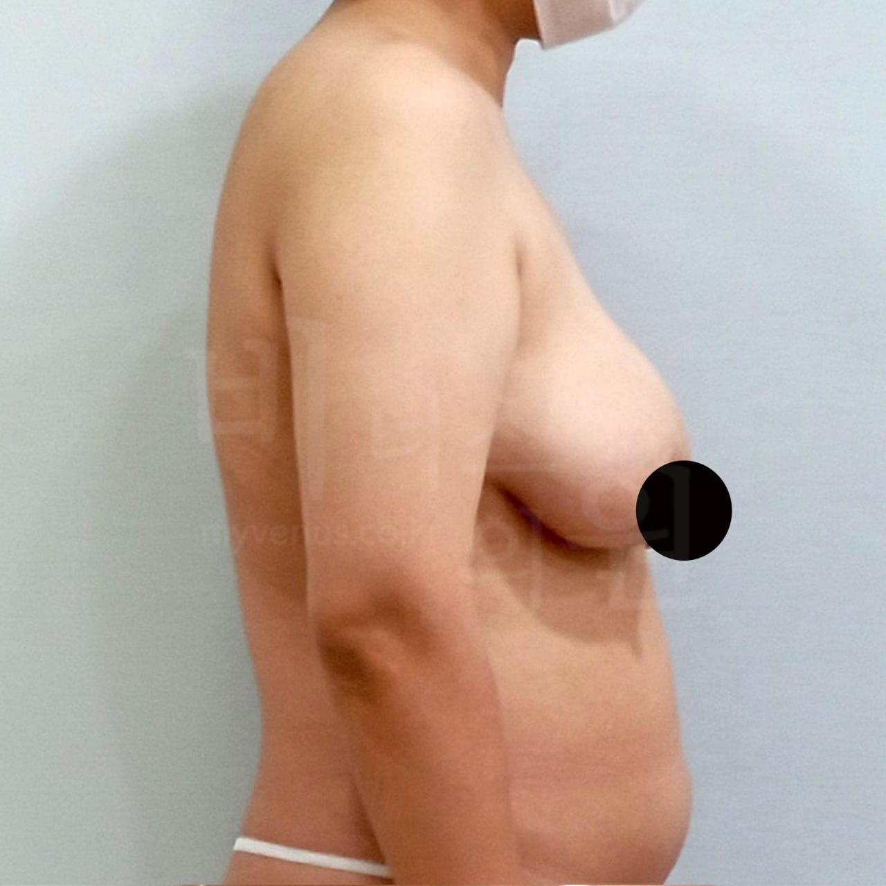 지방흡입 가슴축소 수술 전 측면 비너스의원