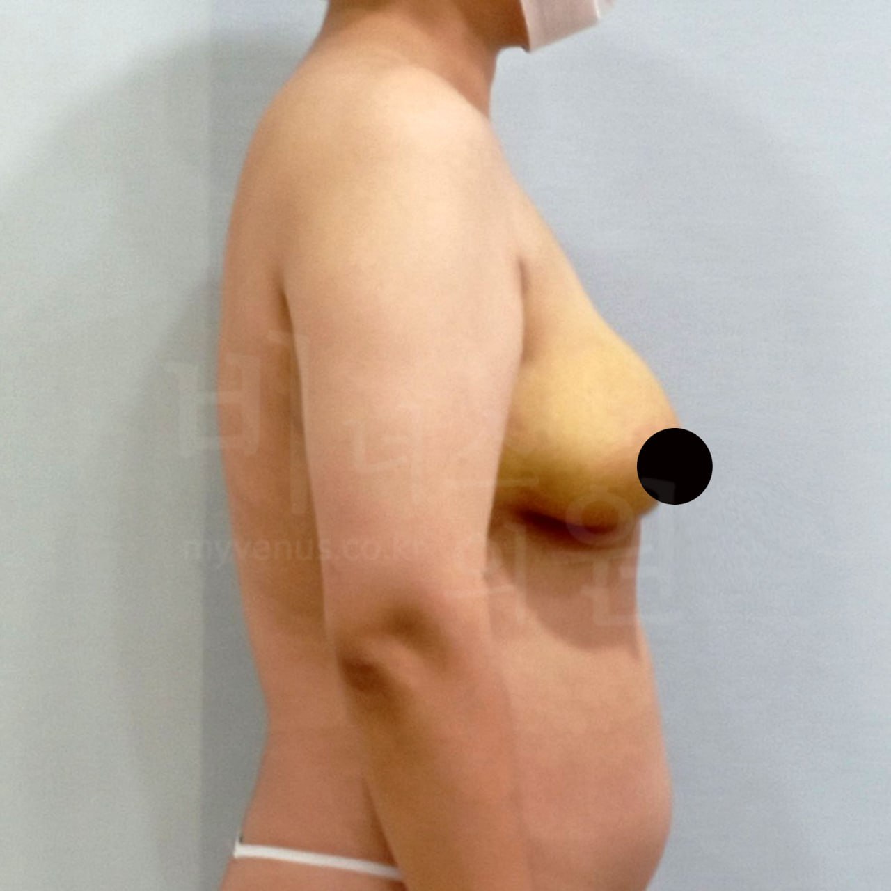 지방흡입 가슴축소 수술 후 측면 비너스의원