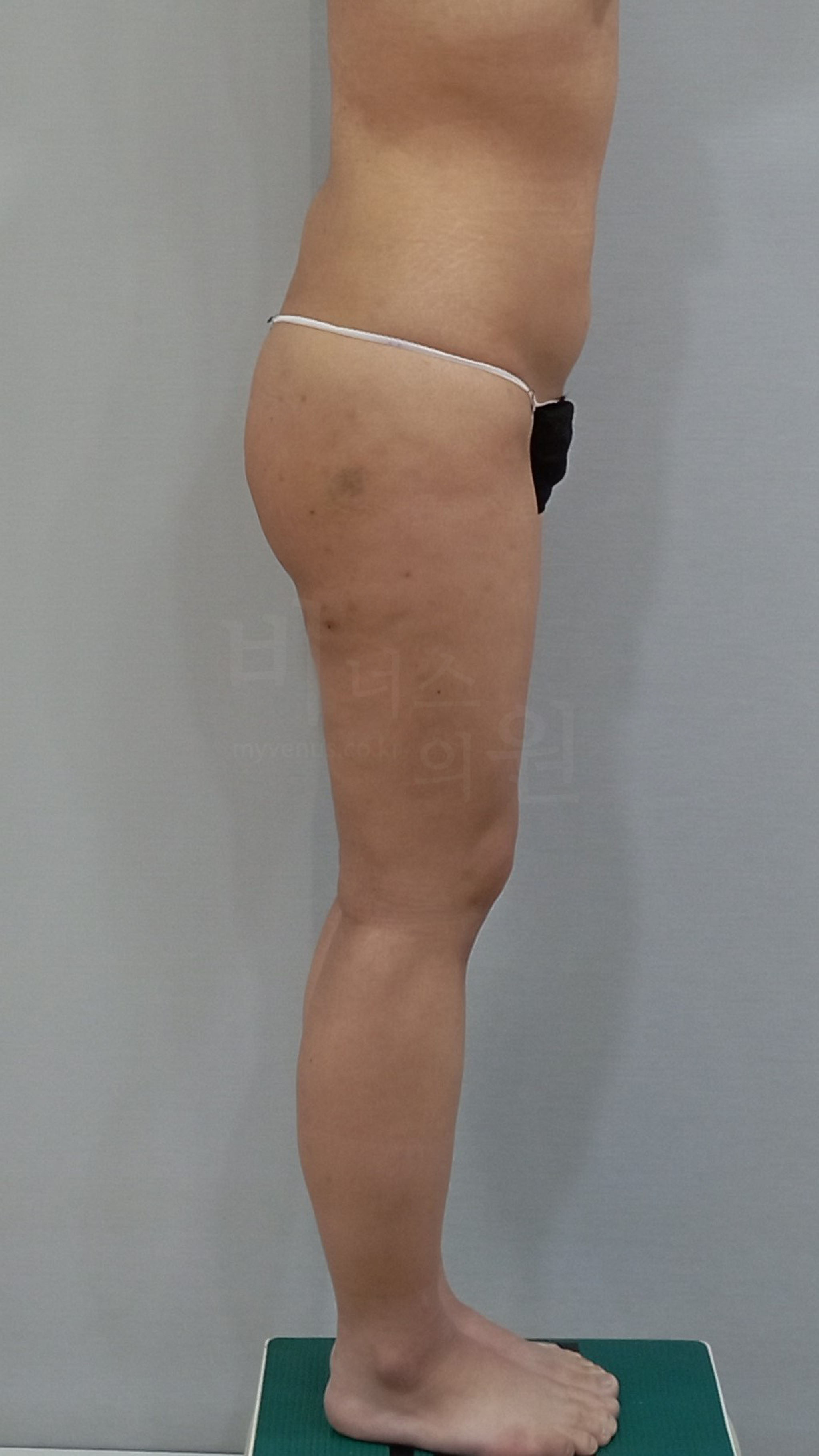 허벅지 지방흡입 수술 후 측면 비너스의원