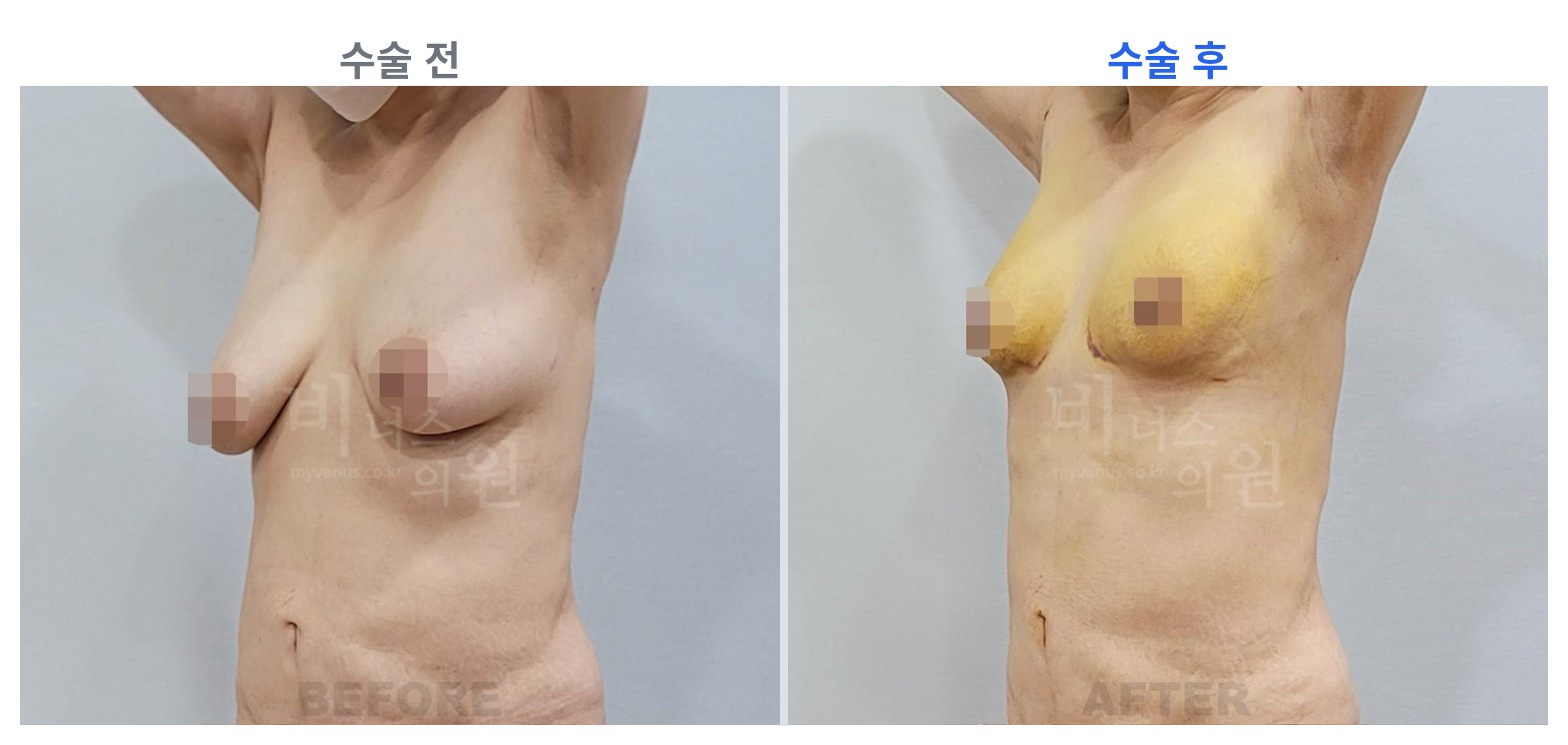 유방하수 표층 지방흡입 수술 전후 45도 비교 비너스의원