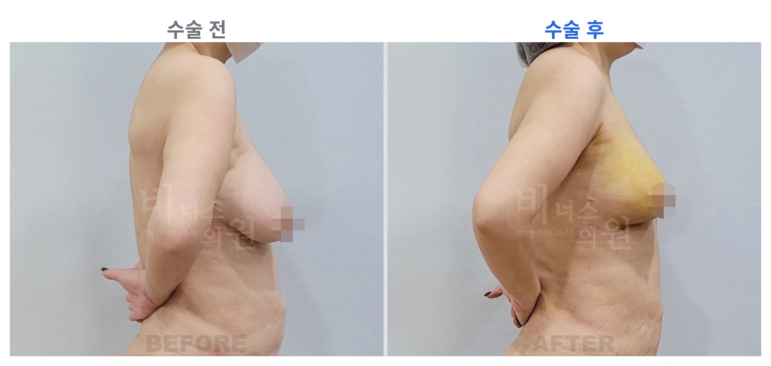 유방하수 표층 지방흡입 수술 전후 측면 비교 비너스의원