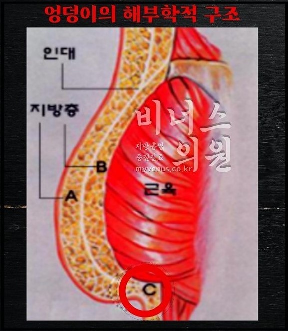 엉덩이볼륨업지방흡입-003 (1).jpg