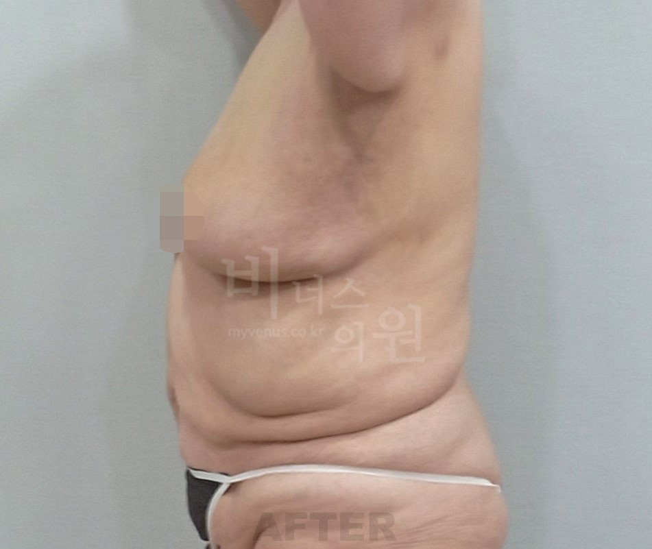유방하수 표층 지방흡입 수술 후 측면 비너스의원