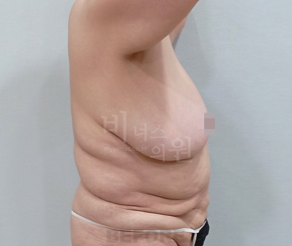 유방하수 표층 지방흡입 수술 전 측면 비너스의원