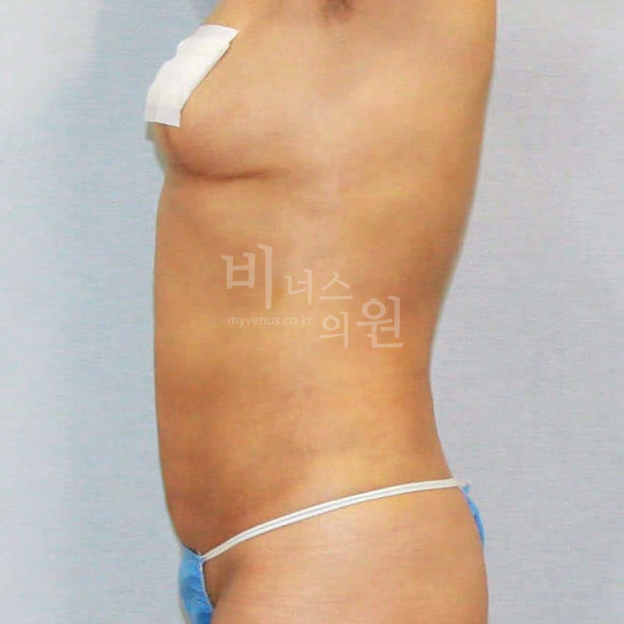 복부지방흡입 후 — 측면