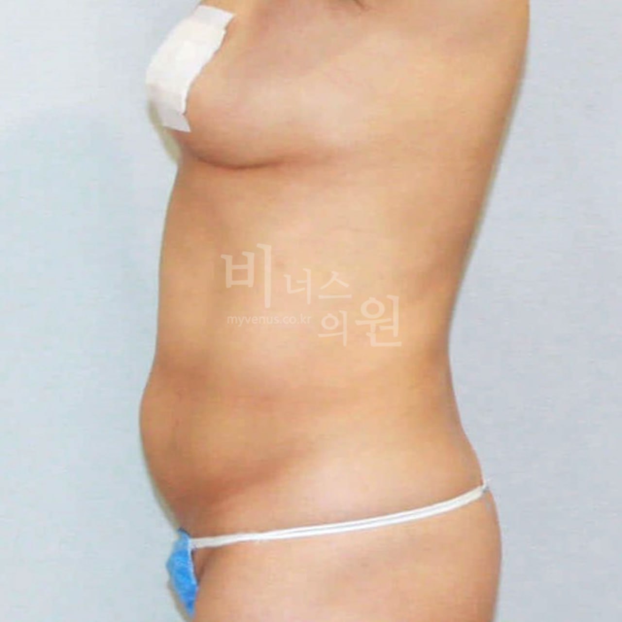 복부지방흡입 전 — 측면