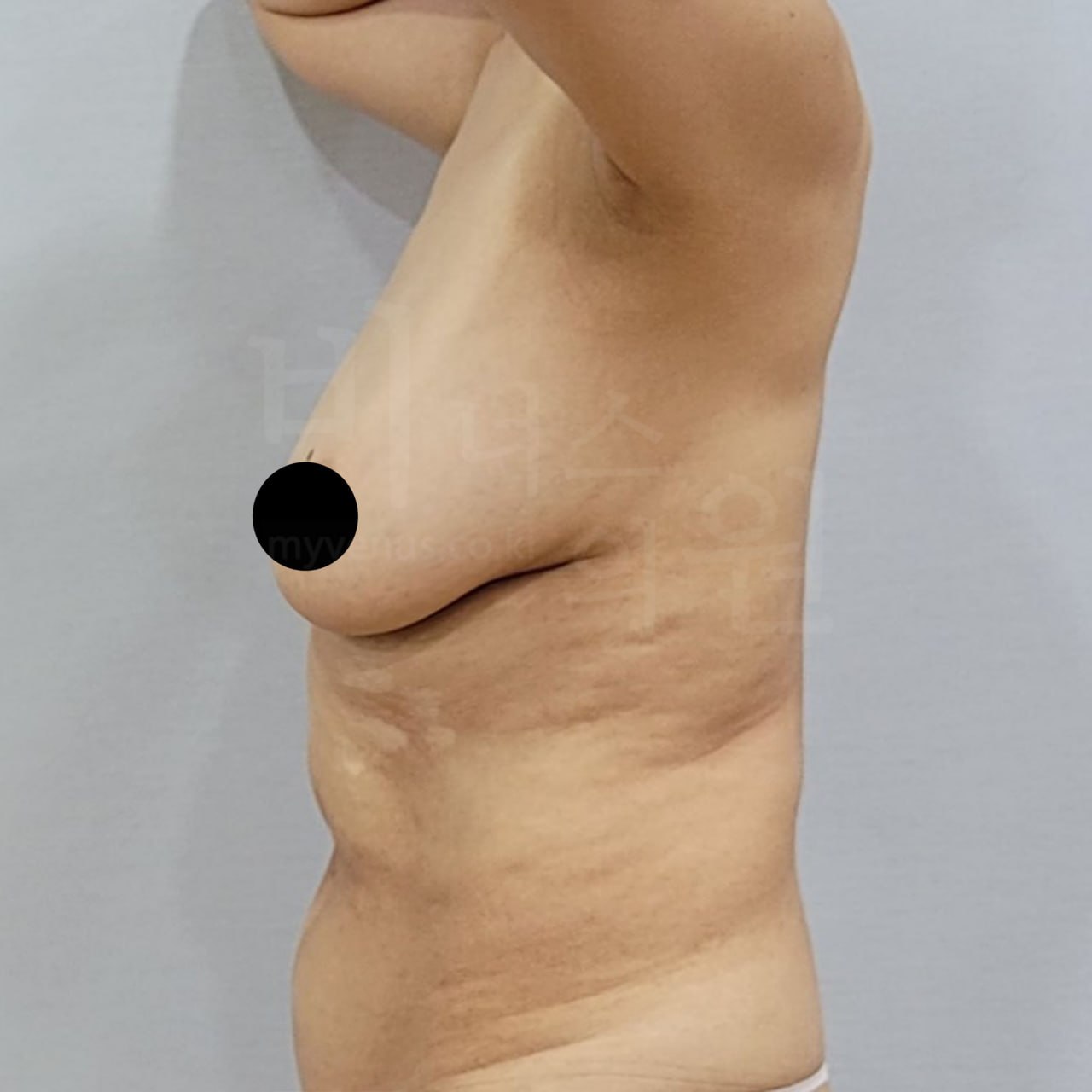 가슴축소 지방흡입 수술 전 측면 비너스의원