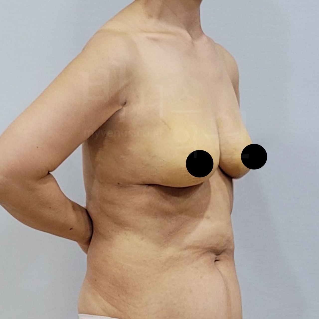 가슴축소 지방흡입 수술 후 45도 비너스의원