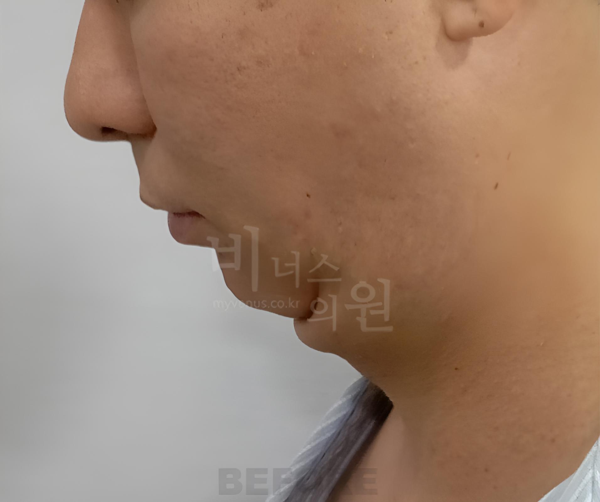 이중턱 지방흡입 수술 전 왼쪽 측면 근접 사진 비너스의원