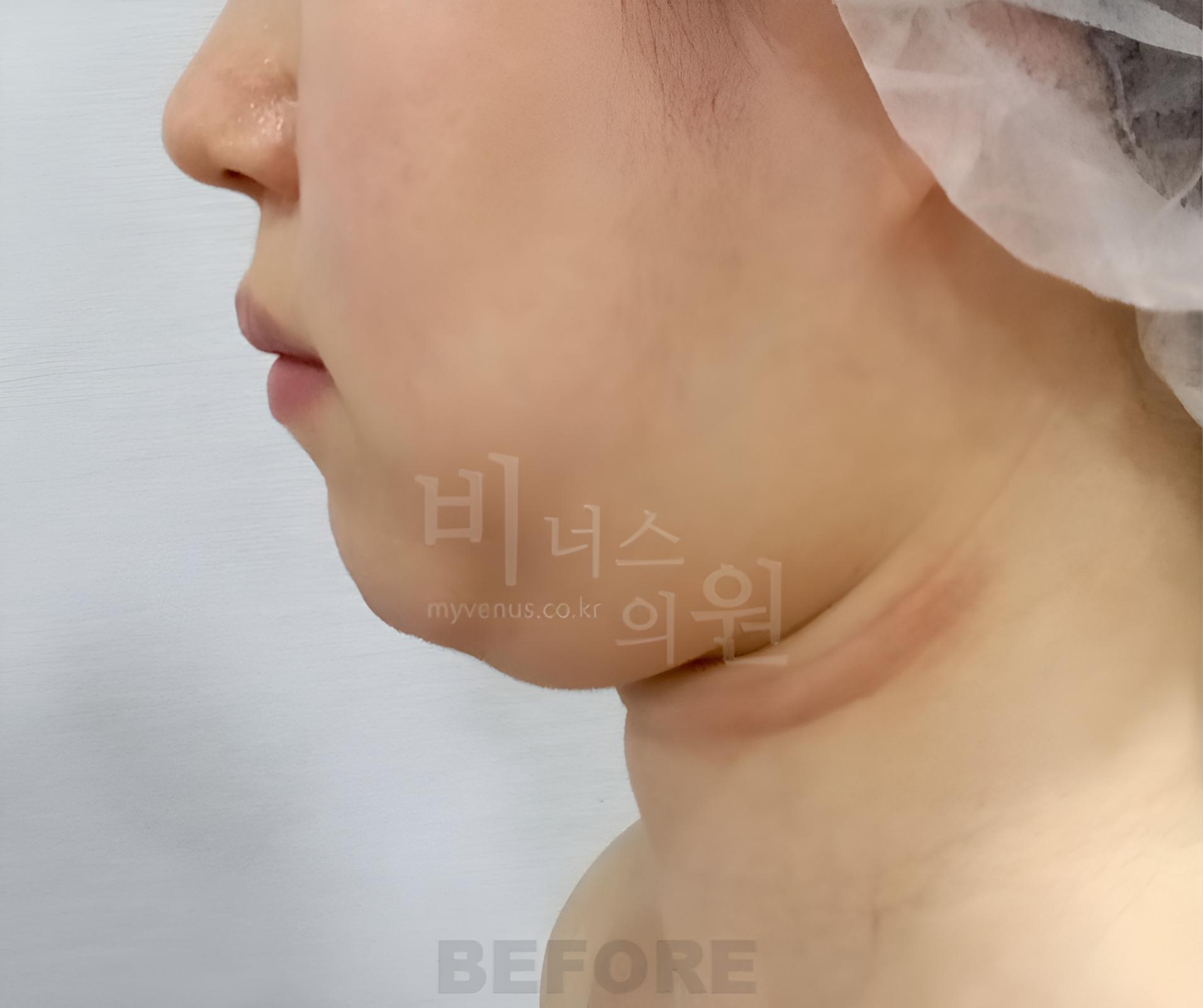 이중턱 지방흡입 수술 전 측면 사진, 턱 밑 볼륨과 목 접힘 비너스의원
