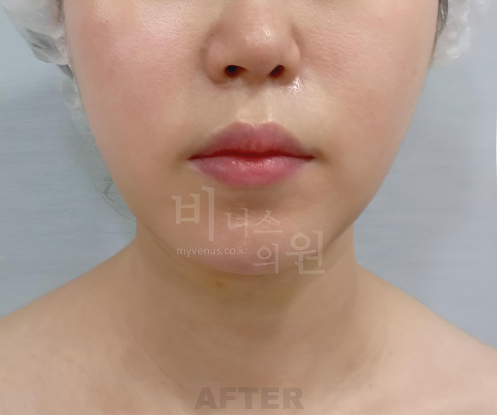 이중턱 지방흡입 수술 후 정면 사진, 턱 아래 윤곽 비너스의원