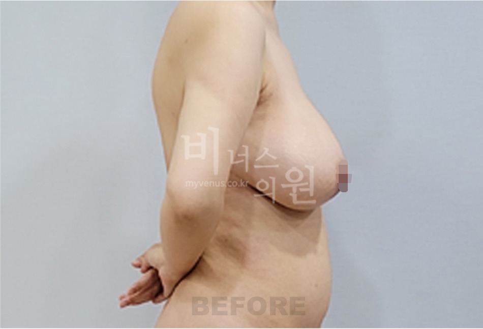 유방 지방흡입 수술 전 반대쪽 측면 비너스의원
