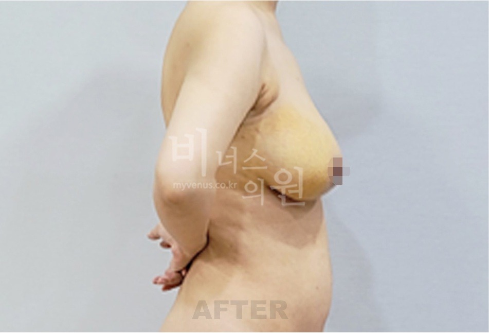 유방 지방흡입 수술 후 반대쪽 측면 회복 중 비너스의원