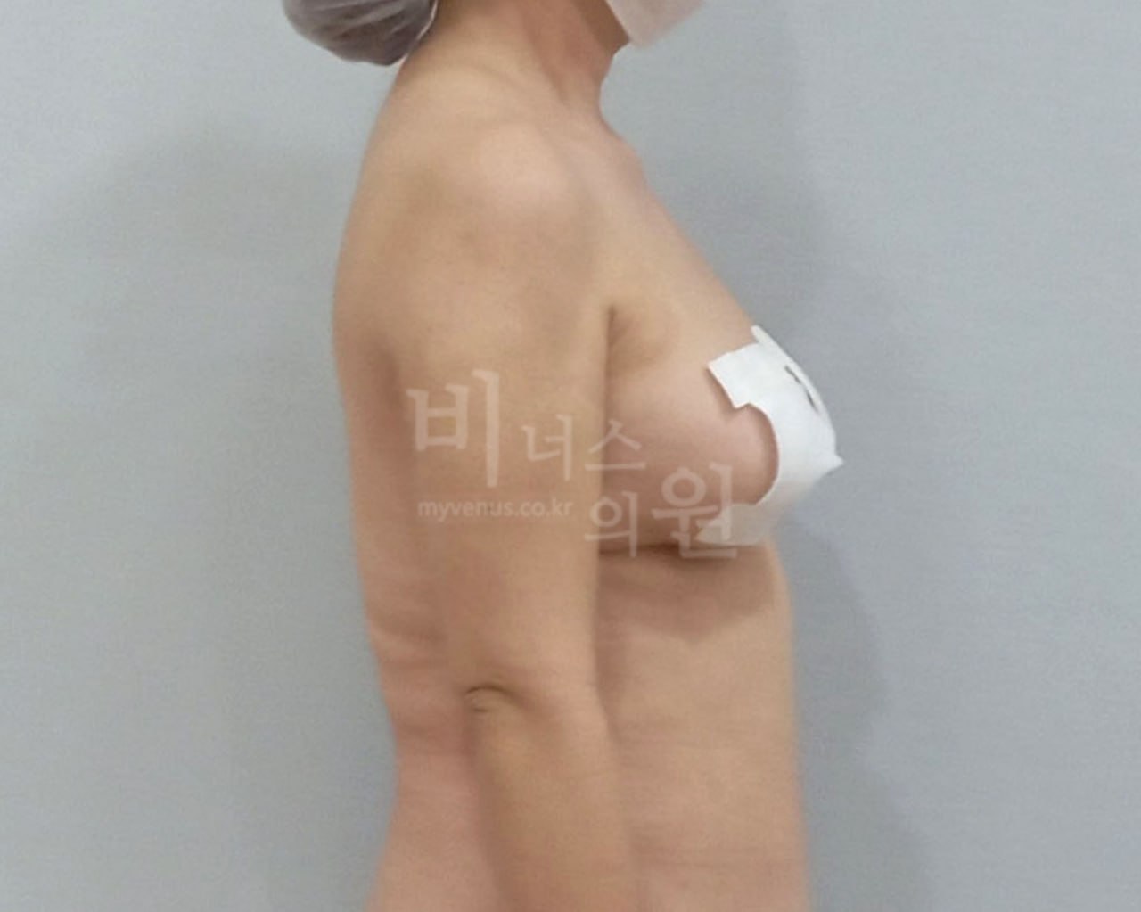 팔뚝 지방흡입 수술 후 측면 비너스의원