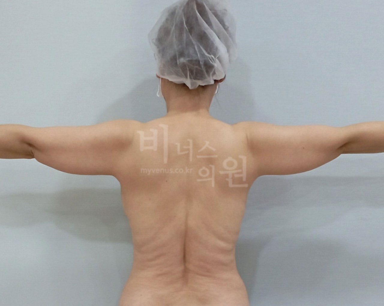팔뚝 지방흡입 수술 전 후면 비너스의원