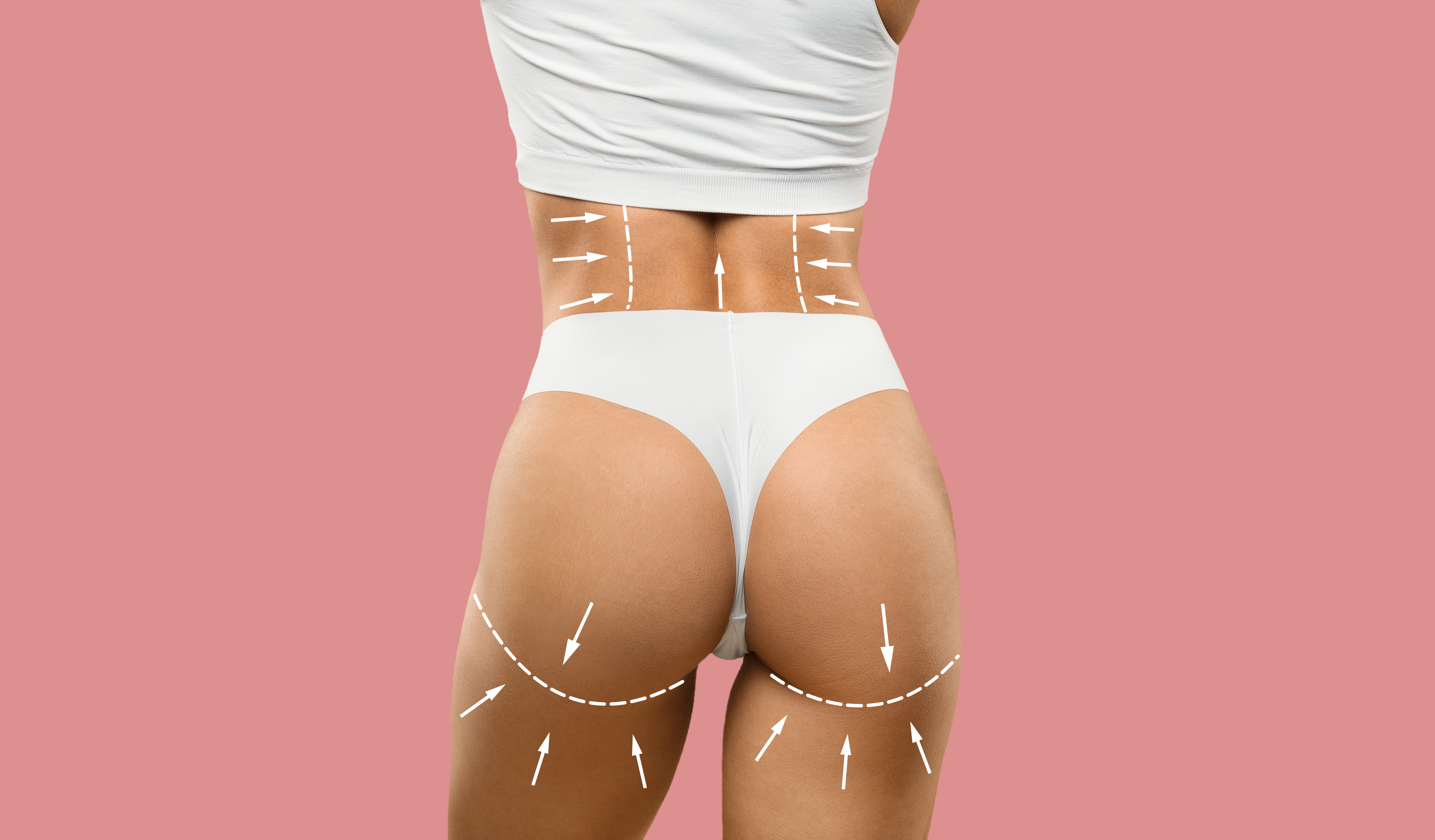 엉덩이축소 볼륨업 지방흡입 수술 비너스의원 체형 개선