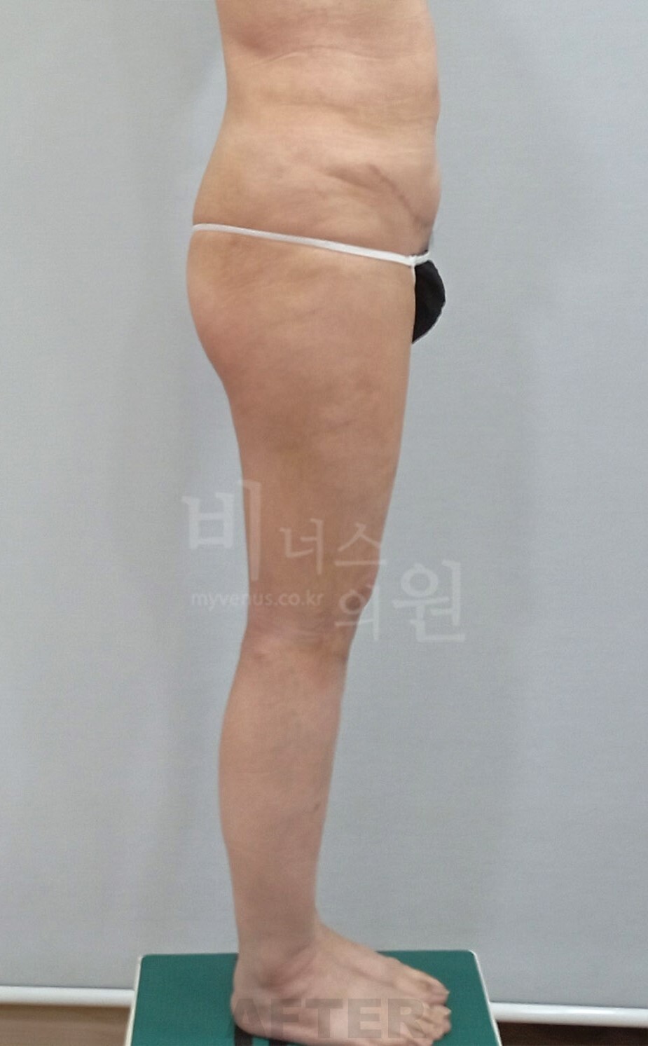 엉덩이축소 지방흡입 수술 후 좌측면 비너스의원