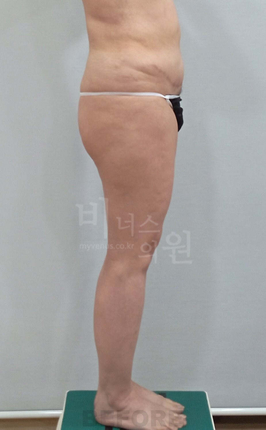 엉덩이축소 지방흡입 수술 전 좌측면 비너스의원