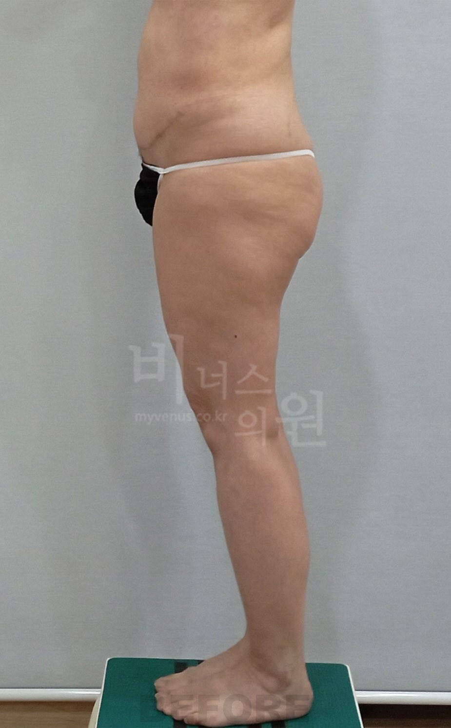 엉덩이축소 지방흡입 수술 전 우측면 비너스의원
