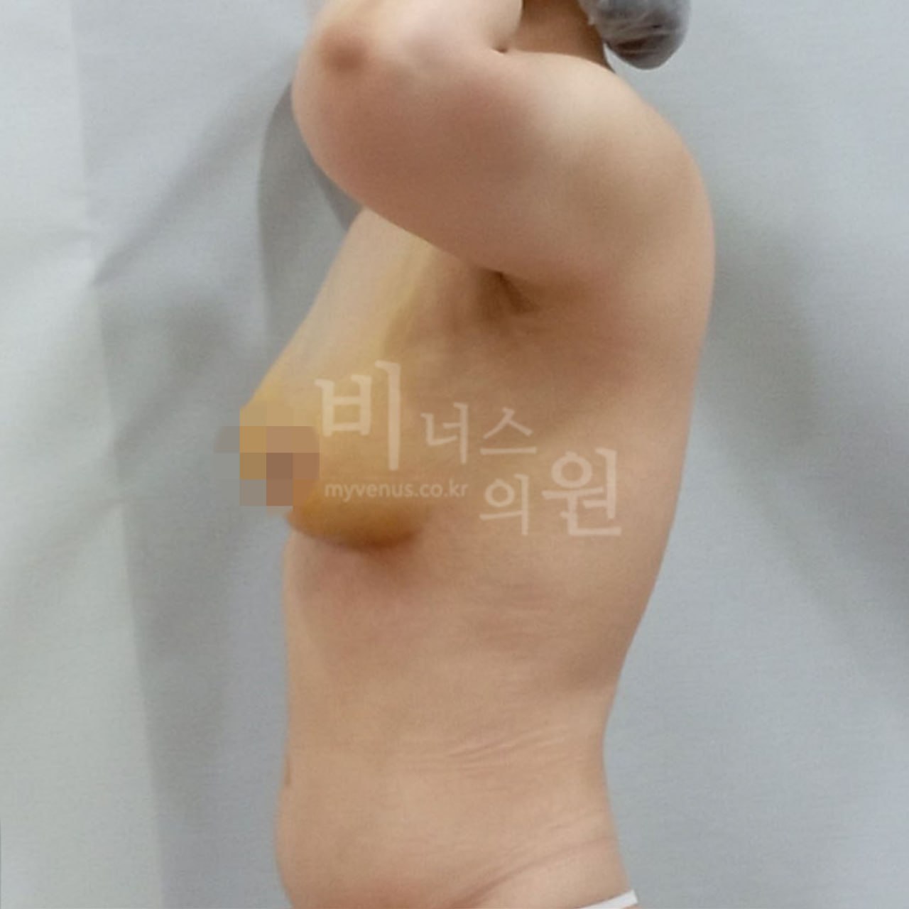 가슴 지방흡입 수술 후 측면 비너스의원
