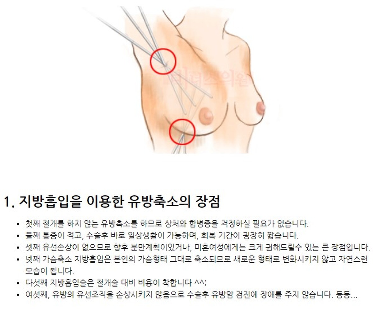 가슴 지방흡입 수술 장점 설명 이미지 비너스의원