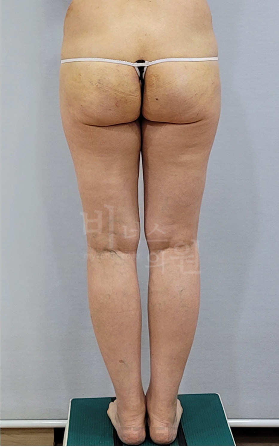 엉덩이 지방흡입 수술 후 후면