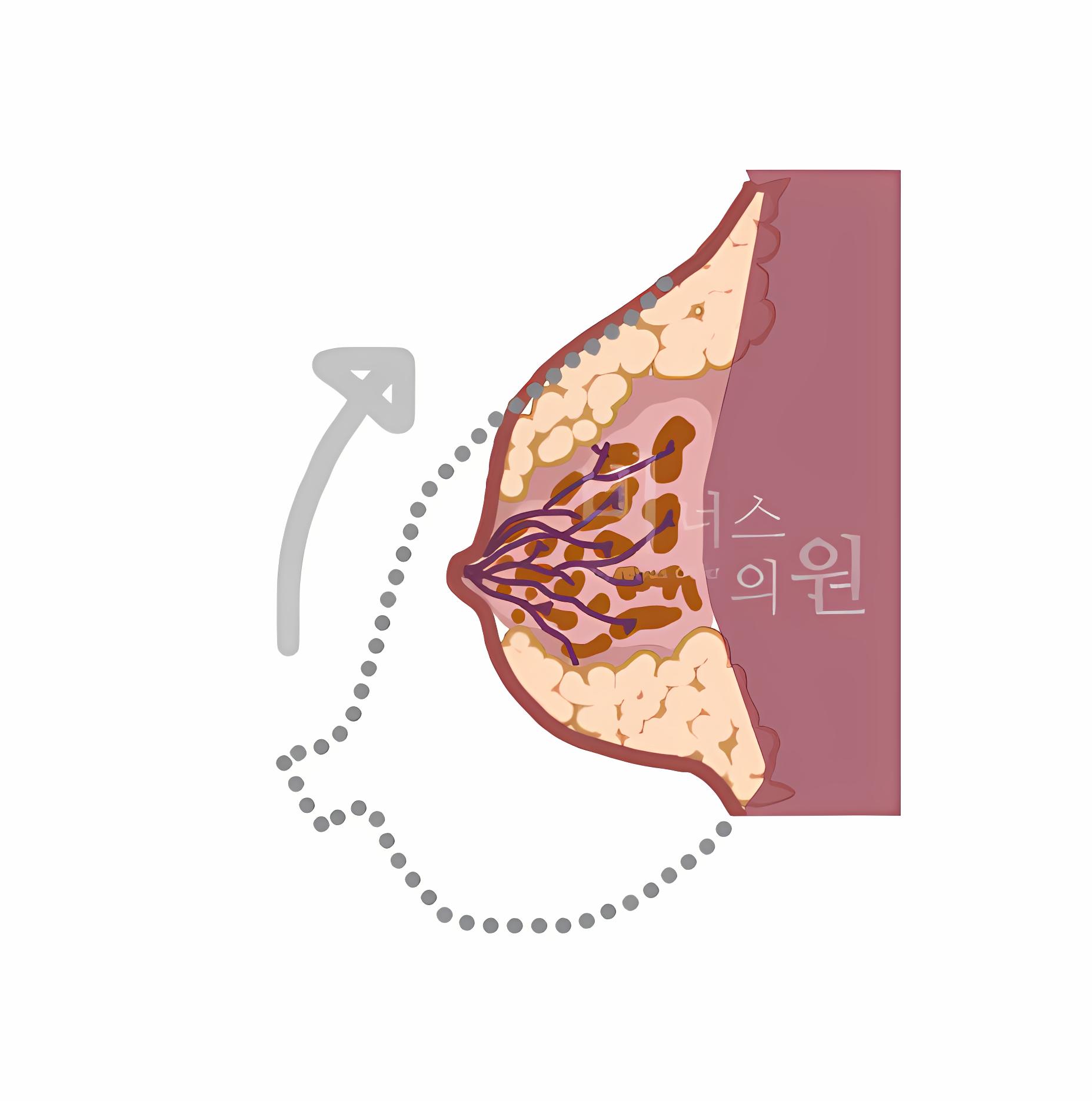 유방 인대 기능 회복과 리프팅 원리 다이어그램